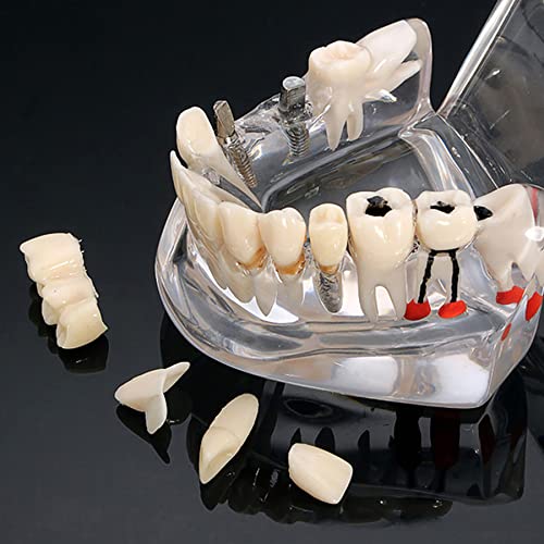 Modelos de implantes dentários Restauração Typodont Dente Modelo Demo Patologia oral Ponte ensina Estudo Clear Color M2001