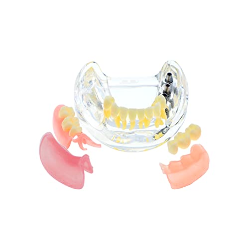Implante dentário TypeDODont Restoration dentes Modelo M6006 Overdenture 3 Implantes Ponte a demonstração